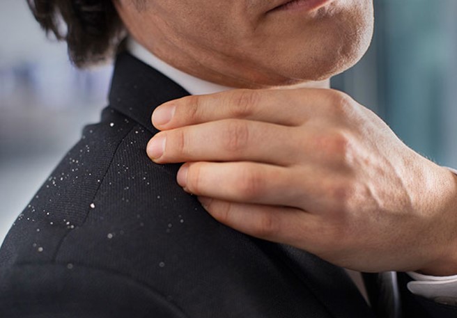 Wie besiegt man lästige Schuppen